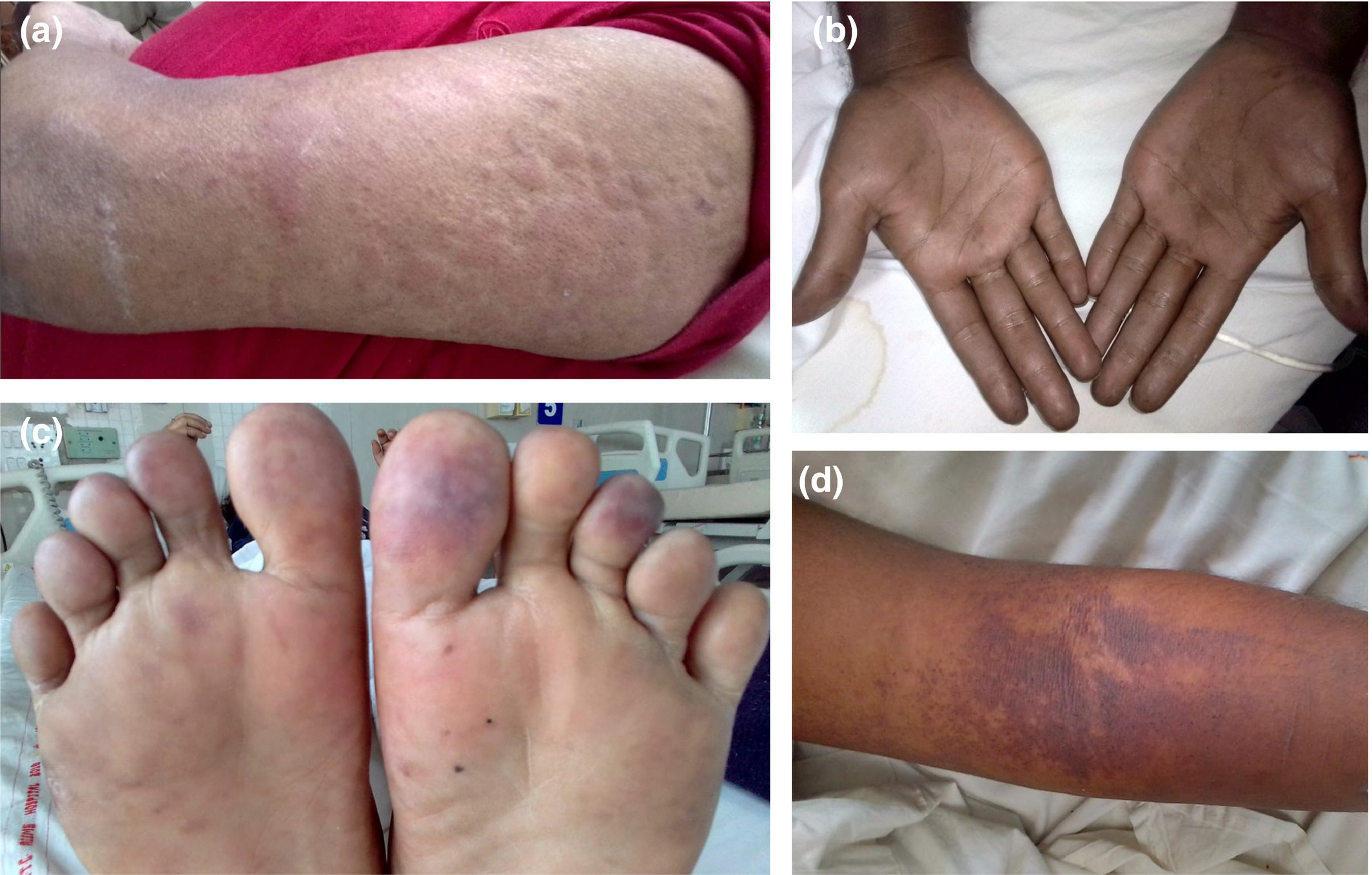 Recognizable Vascular Skin Manifestations Of Sars‐Cov‐2